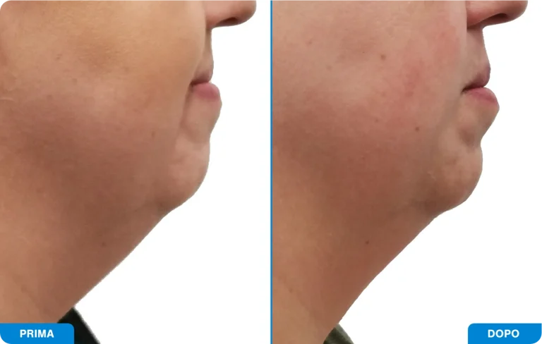 New-Tone3 - Prima e dopo 1