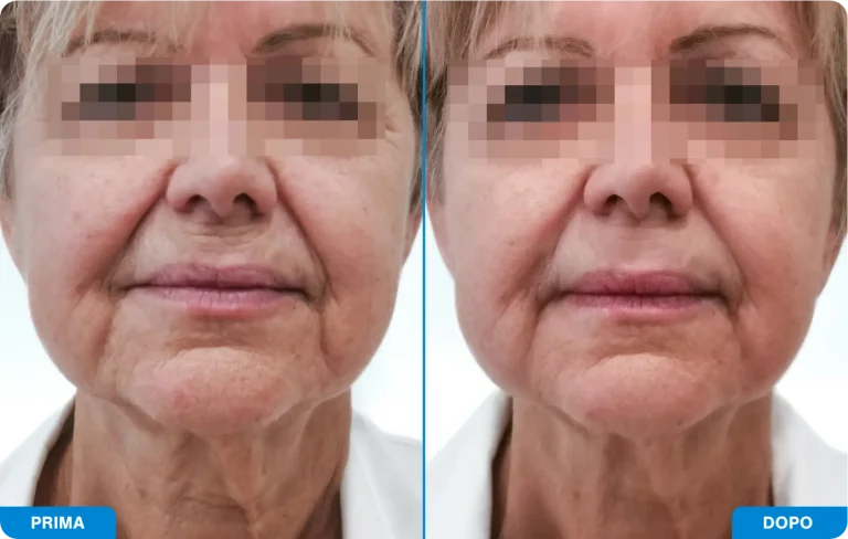 New-Tone3 - Prima e dopo 2