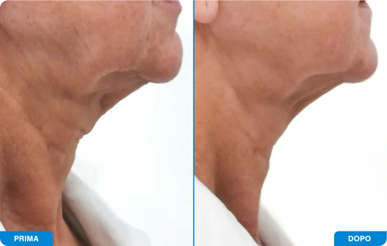 New-Tone3 - Prima e dopo 3