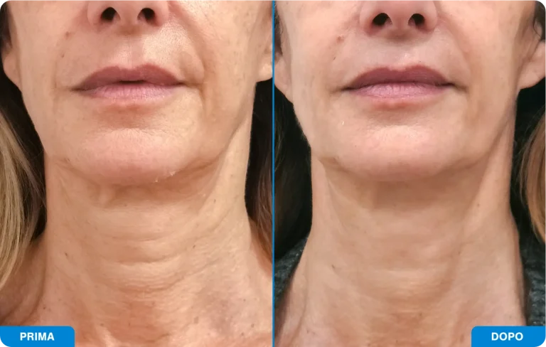 New-Tone3 - Prima e dopo 4