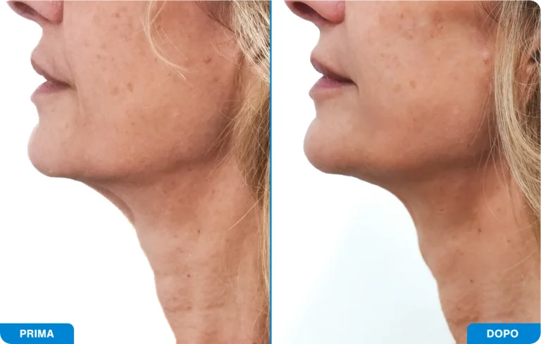 New-Tone3 - Prima e dopo 5