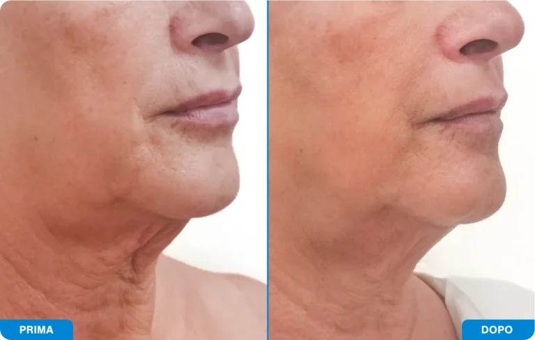 New-Tone3 - Prima e dopo 6