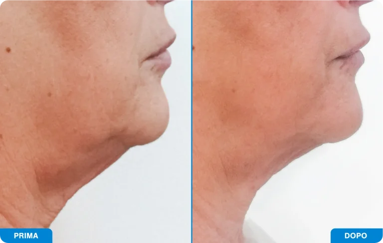 New-Tone3 - Prima e dopo 7