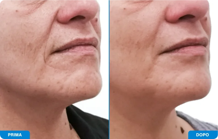 New-Tone3 - Prima e dopo 8