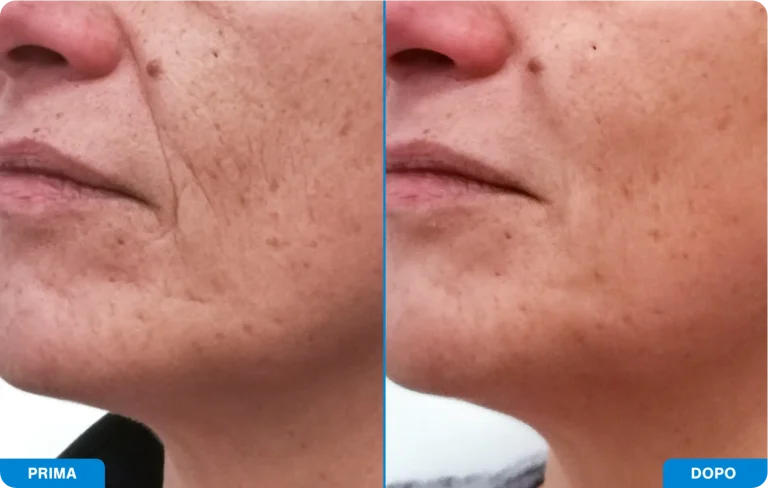 New-Tone3 - Prima e dopo 9