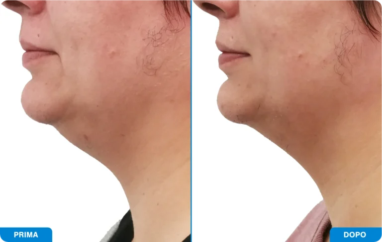 New-Tone3 - Prima e dopo 10