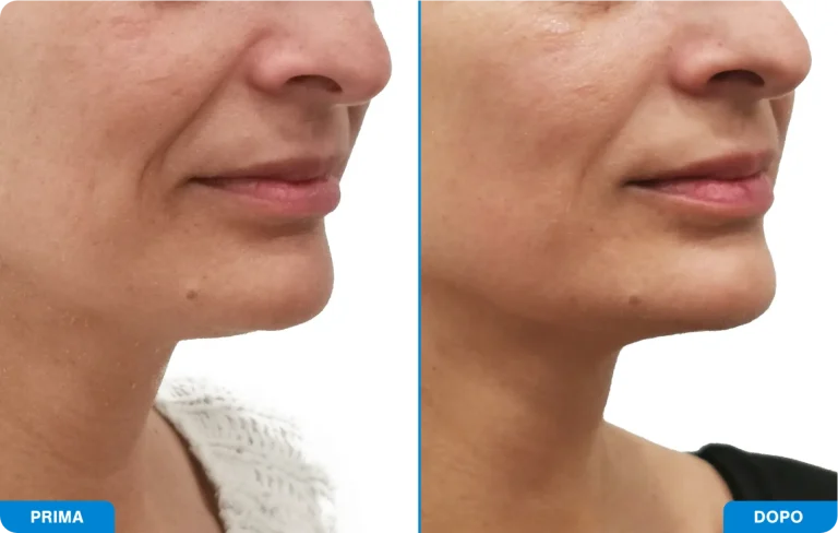 New-Tone3 - Prima e dopo 12